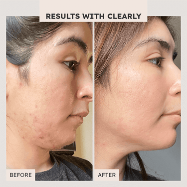 All Clear Advanced Acne System - Clearly Basics